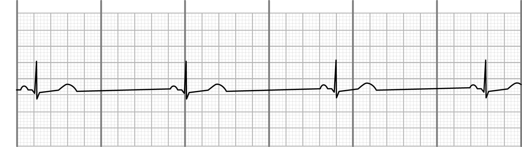 Sinus bradycardia on an EKG