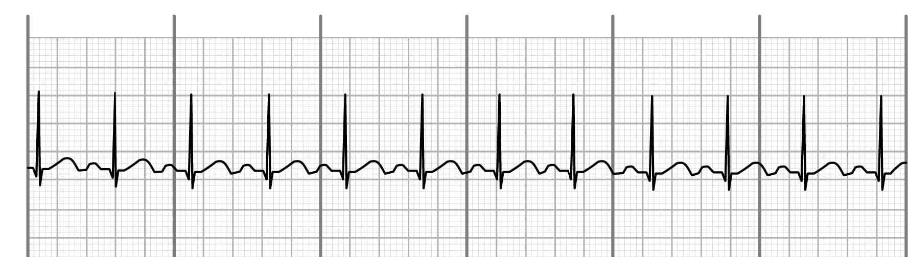 Sinus tachycardia on an EKG