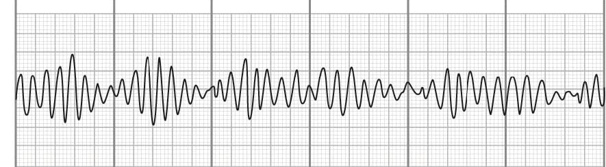 Torsades de pointes on EKG