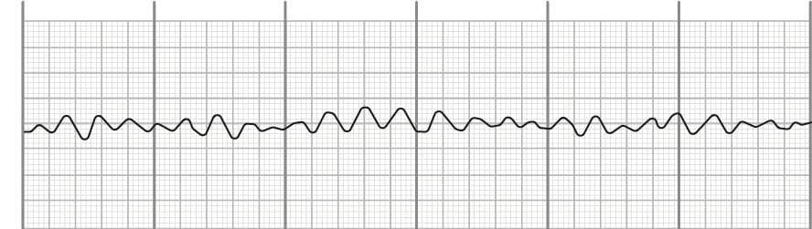 Ventricular fibrillation on EKG