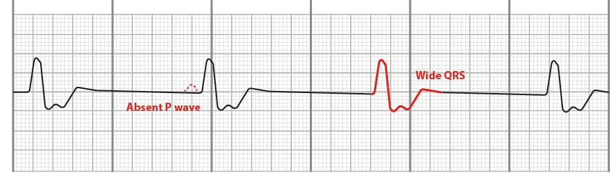 Idioventricular rhythm on EKG