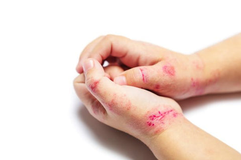 most common eczema in children
