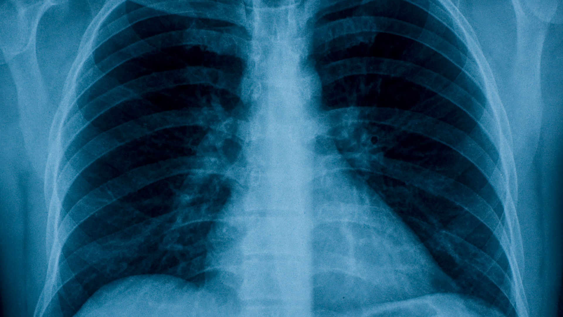 x-ray of lungs