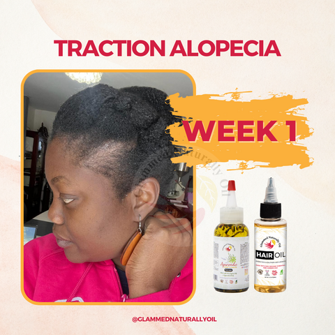 Traction Alopecia 1 week result 