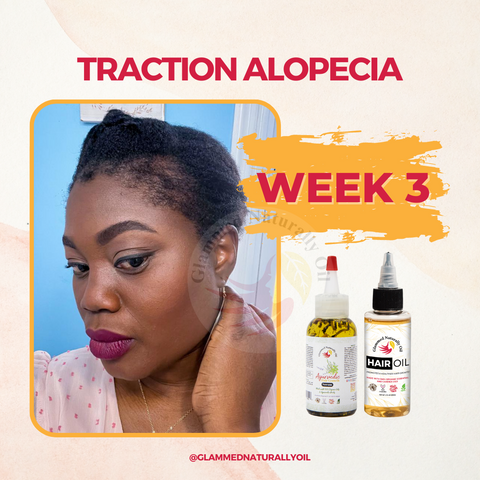 Traction Alopecia week 3 results