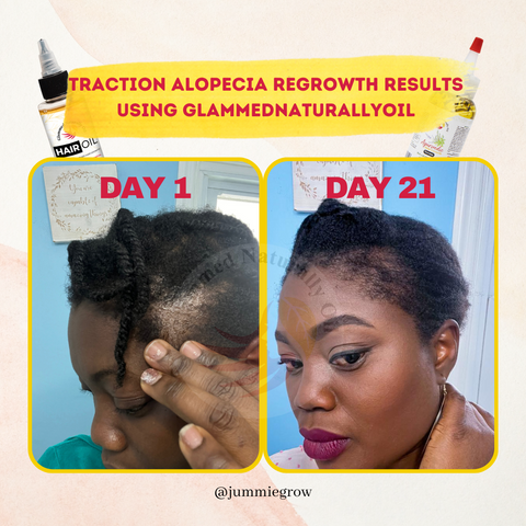 Traction alopecia before and after