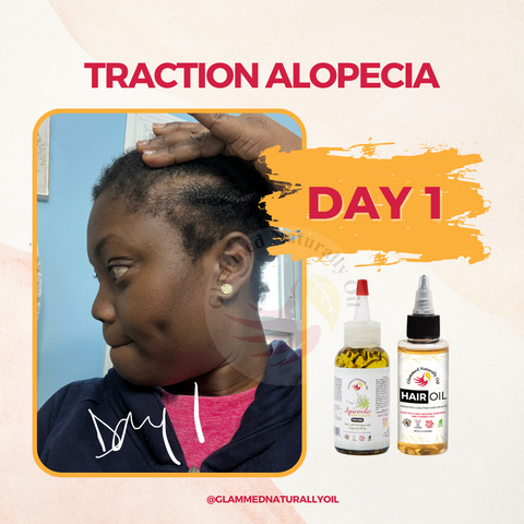 Traction Alopecia Day 1 