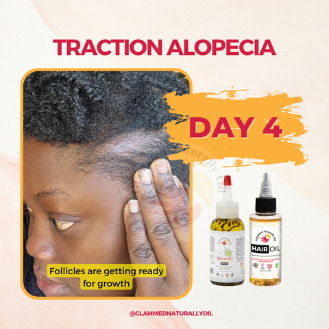 Traction Alopecia Day 4