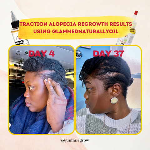 Before and after traction alopecia results 