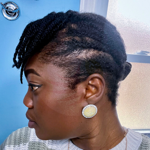 6 weeks after results from traction alopecia