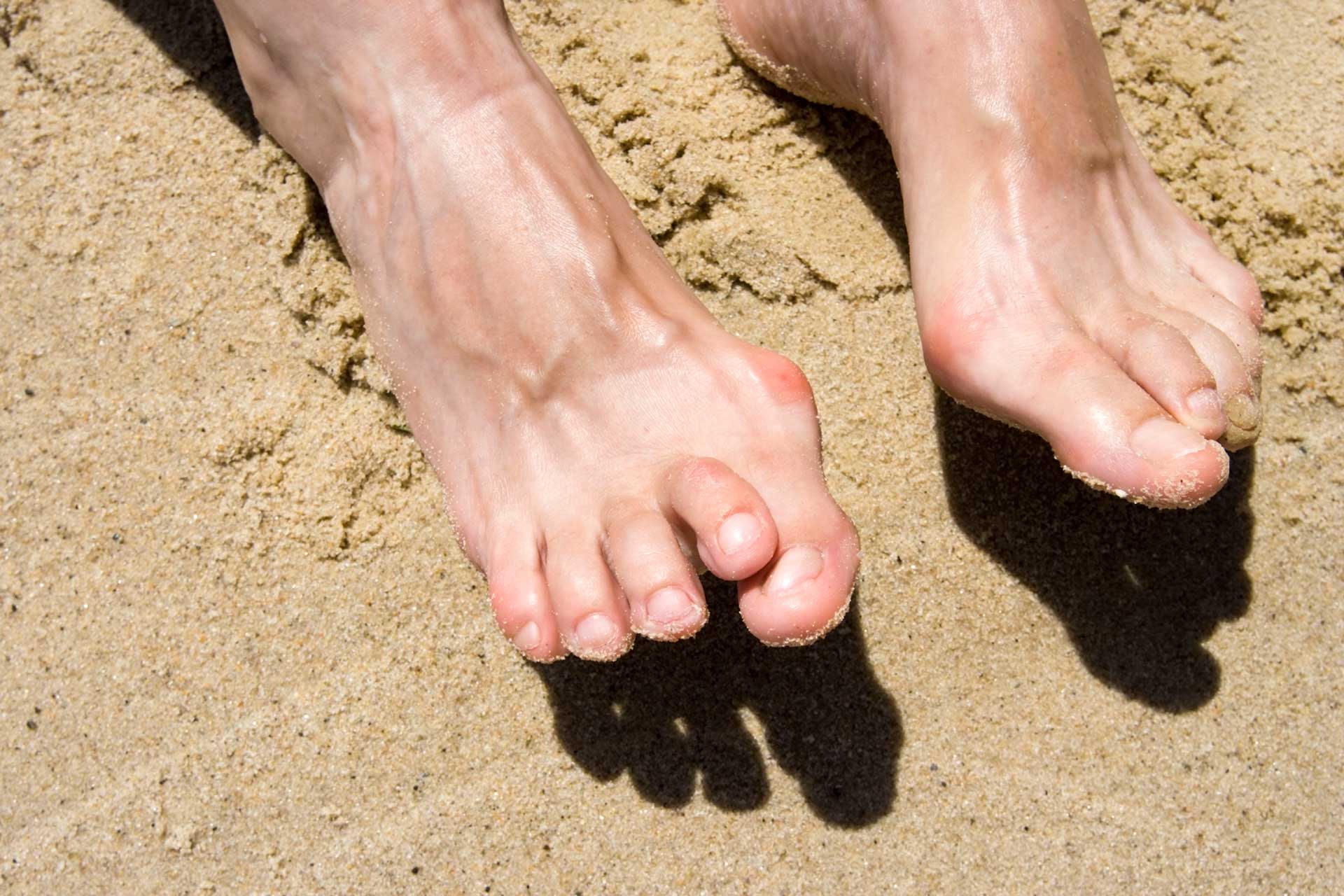 Wearing Flip Flops May Lead to Hammer Toes