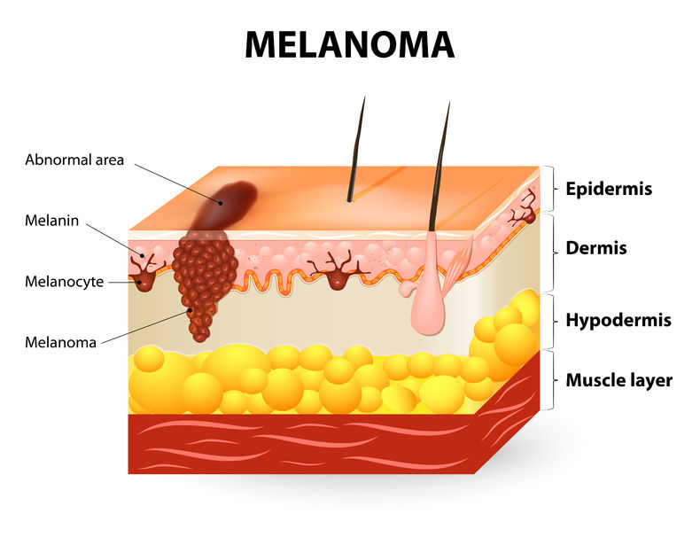 how-to-spot-the-early-signs-of-melanoma-skin-cancer-babyface