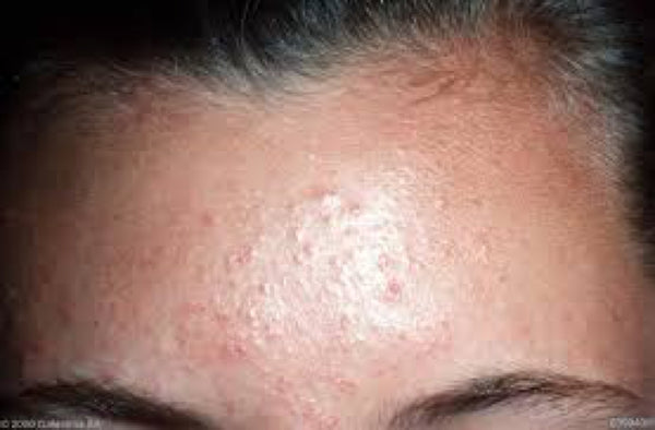 How To Treat Fungal Acne Aka Pityrosporum Folliculitis Or Malassezia