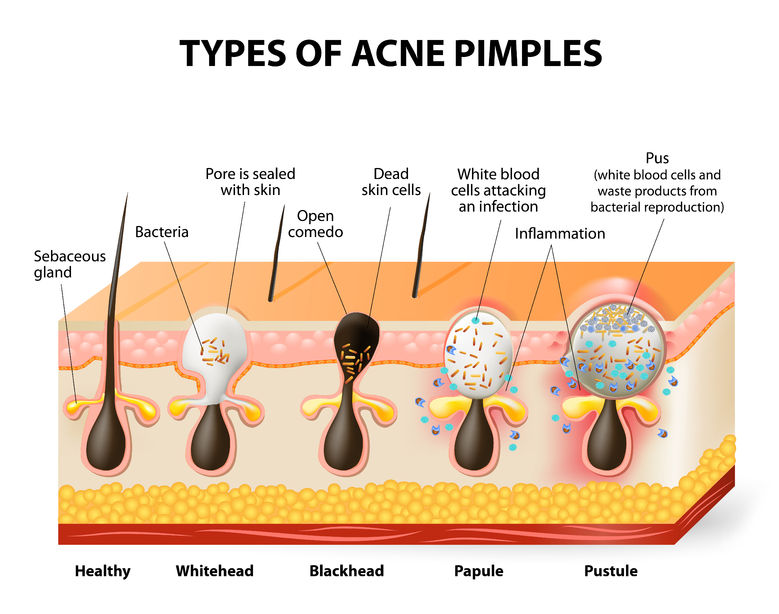 Babyface - Guide to Acne Treatment