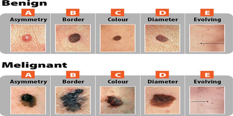 Examples Of Skin Cancer Types