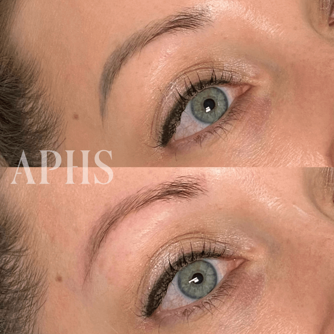 laser removal before and after one session (2) (1) (2).png__PID:cf3d57da-3351-4801-808e-1dbc649c2b10