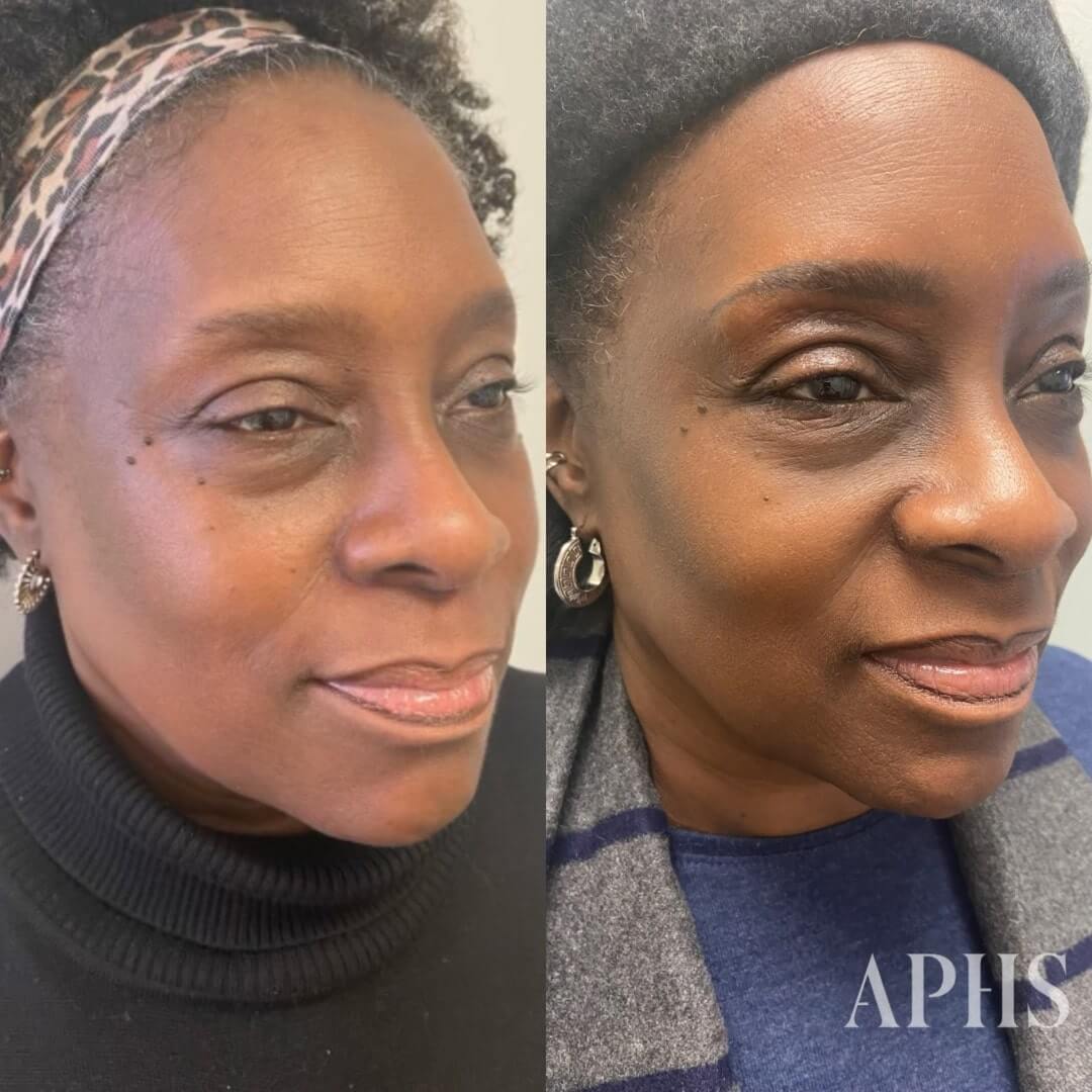 Ombre brow before and after on dark skin tone, eyebrow is very light and has no tail in before photo, but is well defined while still looking natural in the after photo