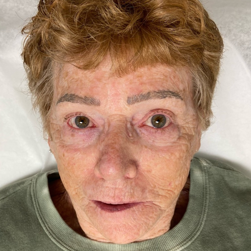 An older woman laying down. Her eyebrows are a very dark gray and look like they've been drawn in marker. She had microblading. 