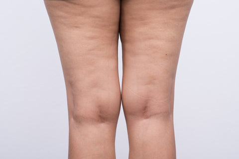 3 Easy Ways to Reduce Cellulite At Home: – Callyssee
