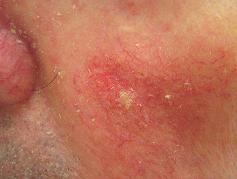 skin cancer causing cosmetics