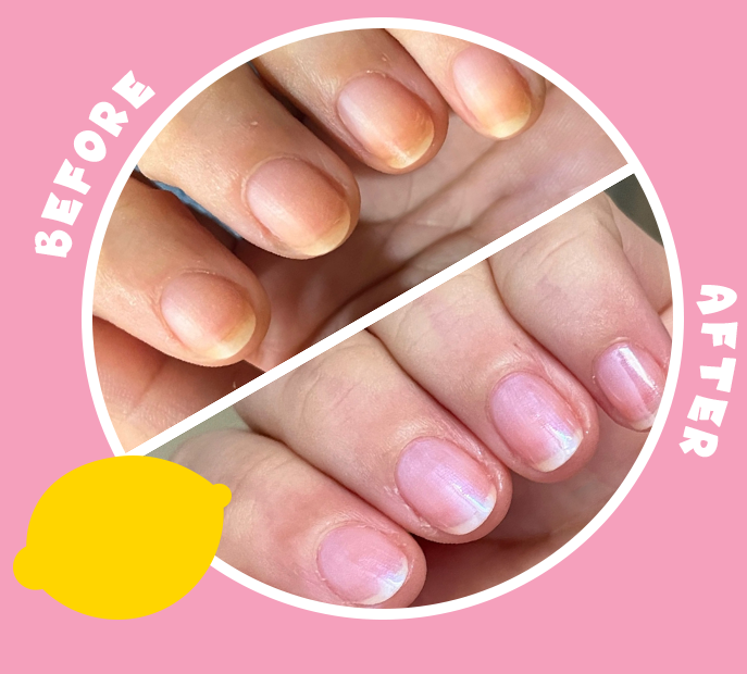 before and after showing treatment of discolored nails