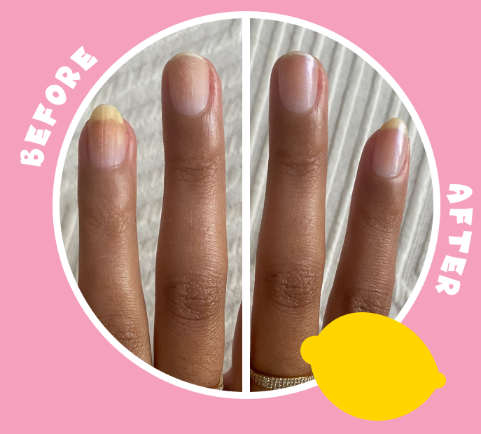 before and after showing treatment of yellowing of nails