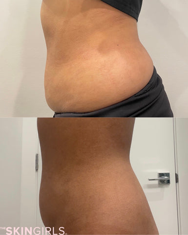 Non Invasive Body Contouring: Tight Skin without Surgery - En