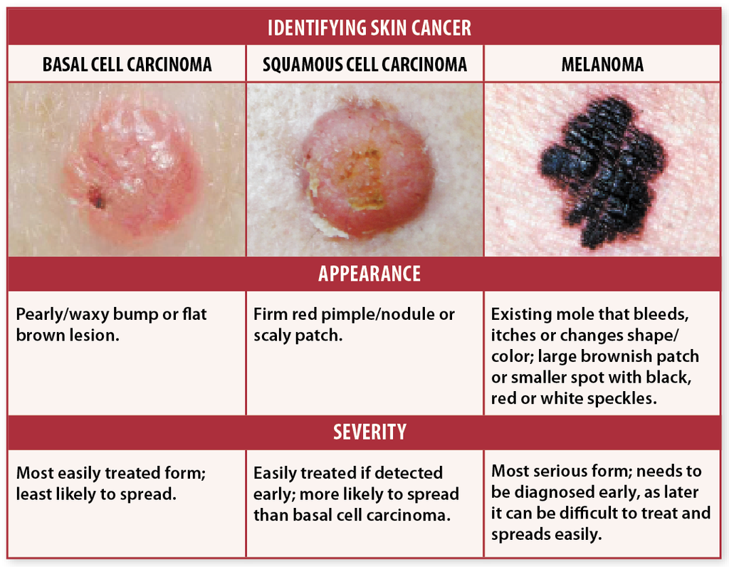 Melanoma Skin Cancer Signs