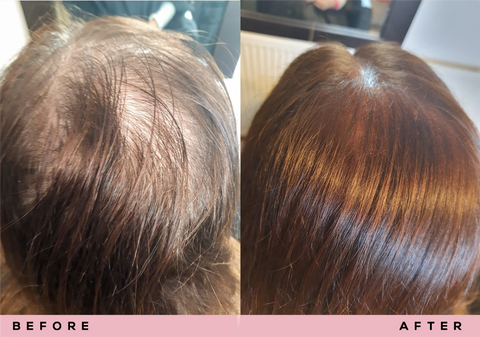 Before & After Hair Gain