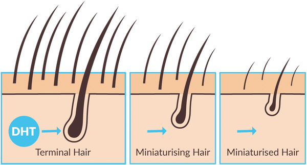 DHT attacks hair follicles graphic 