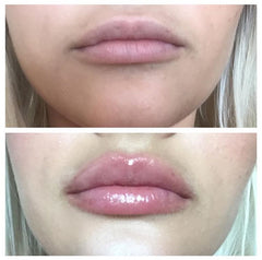 Lip Voltage