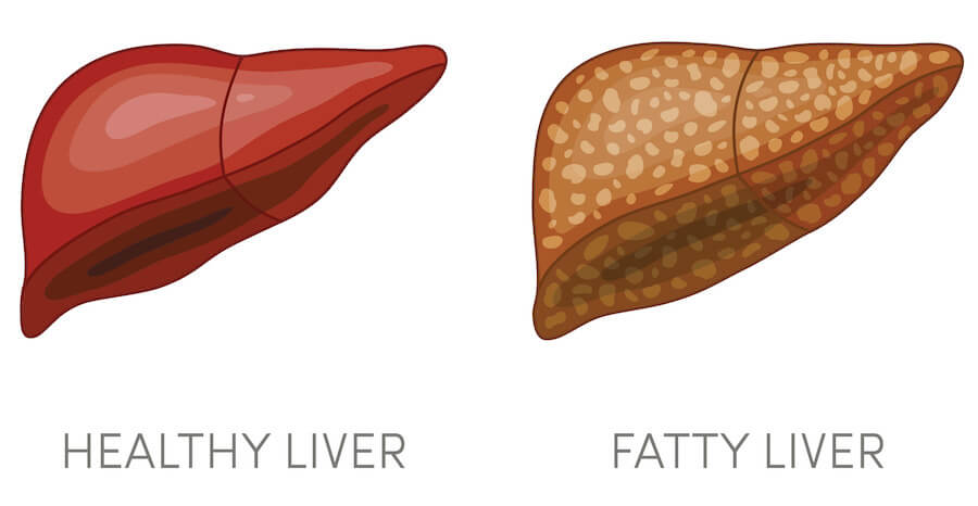 healthy liver and fatty liver animation