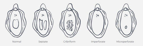 Hymen anatomy