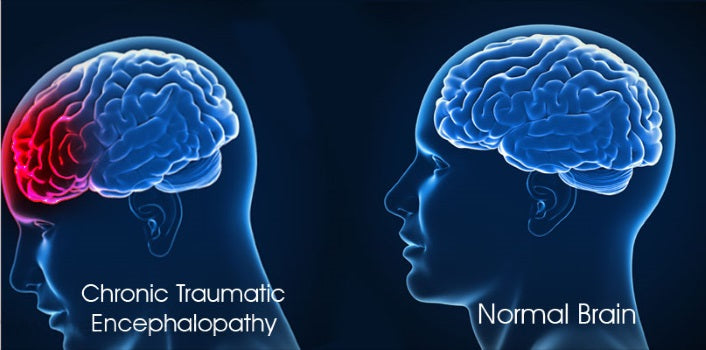 Chronic traumatic encephalopathy – ZimSeller