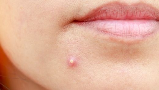 hormonal acne ayurvedic skin care