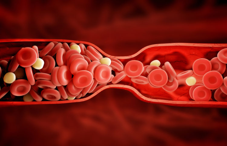 deep vein thrombosis blood clot