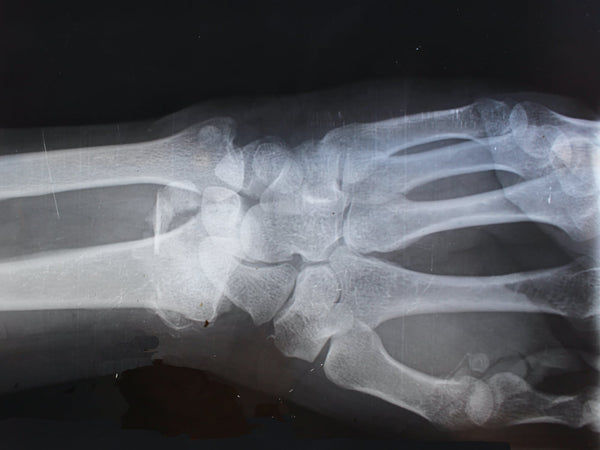 bones xray