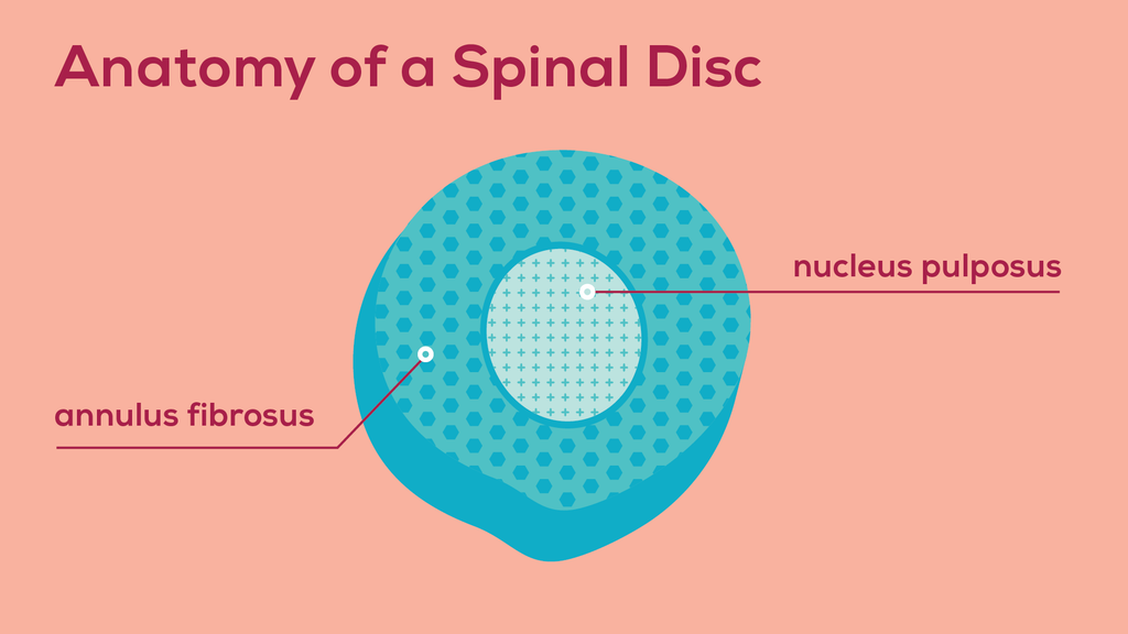 The anatomy of a spinal disc, with the nucleus pulposus on the inside and the annulus fibrosus encircling it.