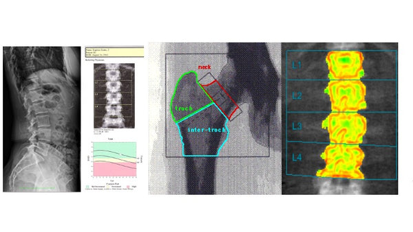 montage of spinal scans, bone density scane, hip bones