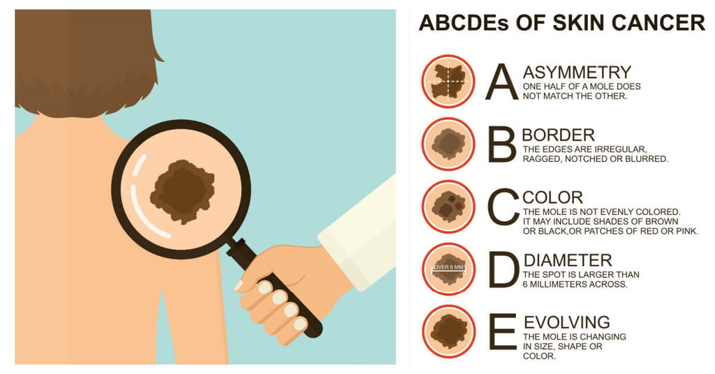 The ABCDE warning signs of melanoma skin cancer