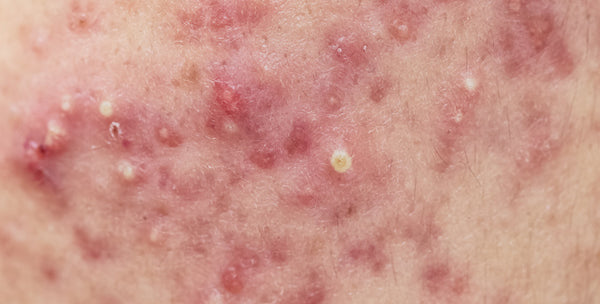 A photograph of inflammatory, cystic acne
