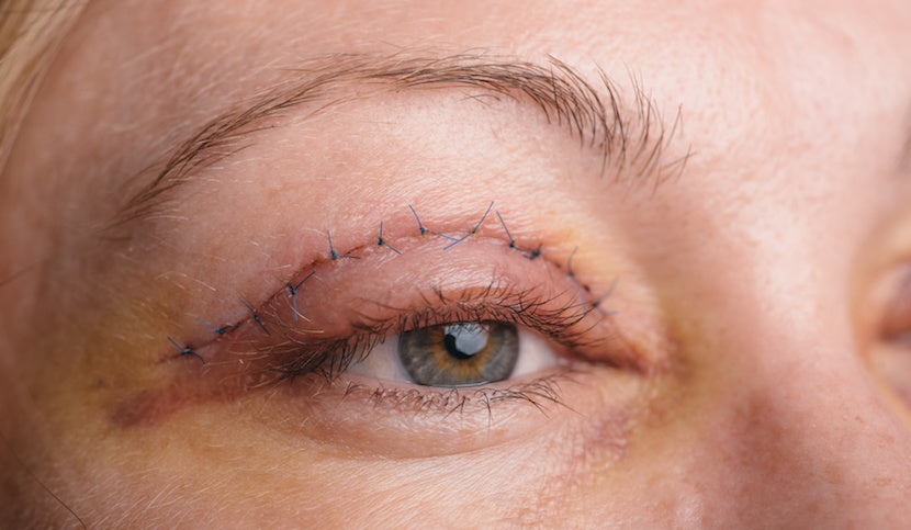 types of eyelid surgery