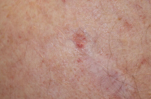 Basal cell carcinoma can look like a pimple SLMD
