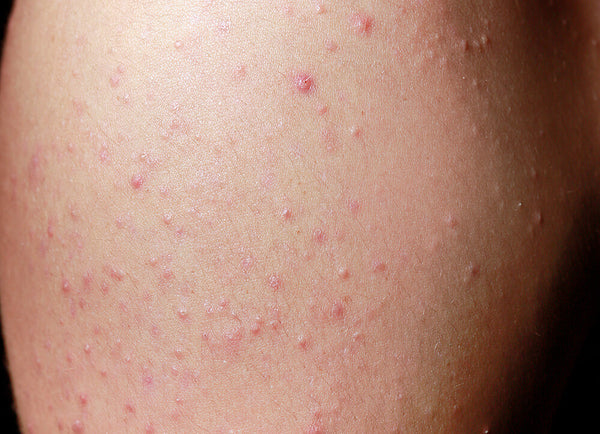 A closeup photo of an arm with inflammatory and non inflammatory acne