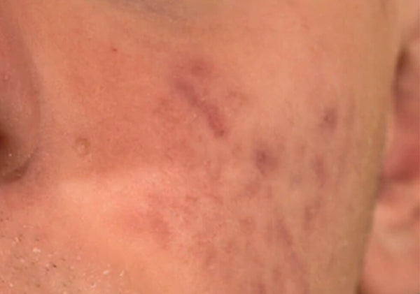 Closeup photo of post-inflammatory hyperpigmentation from acne