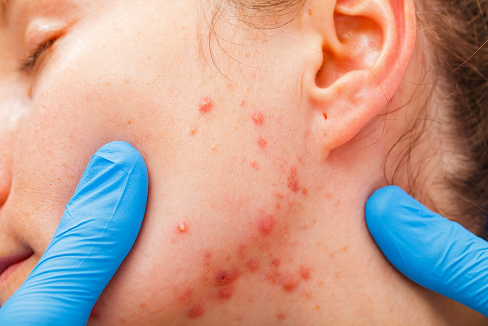 A woman with cystic acne that may benefit from treatment with Accutane