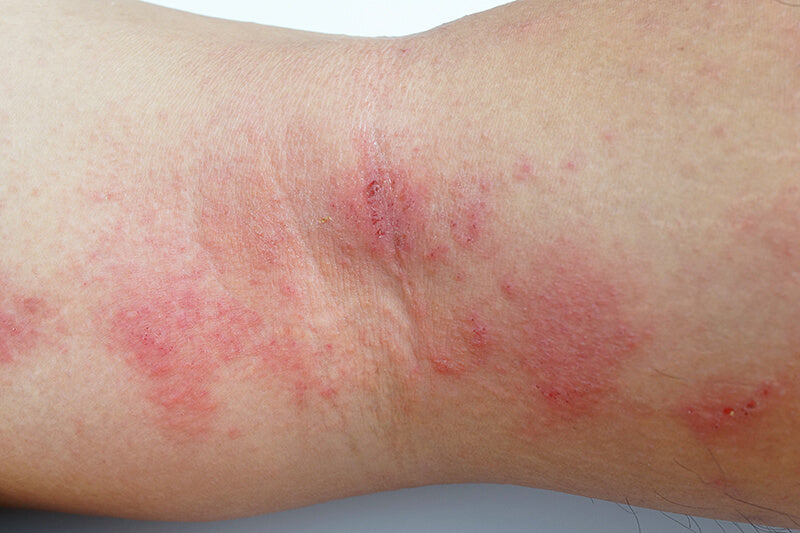 Eczema on back of the leg