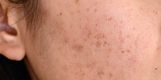 Hyperpigmentation