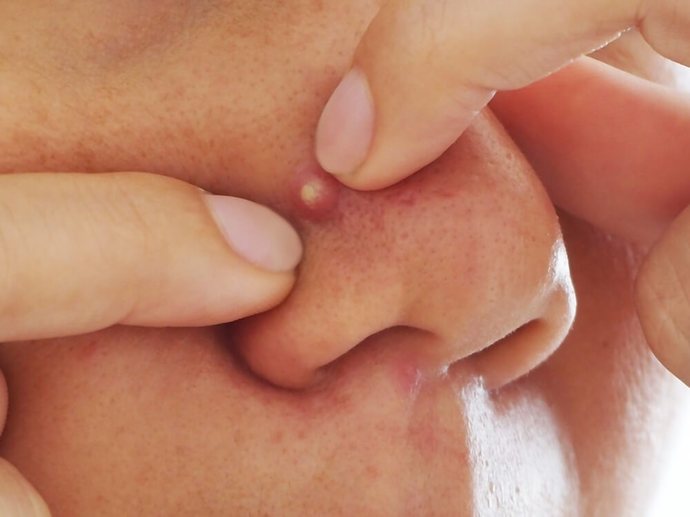 Picking a pimple which can cause damage