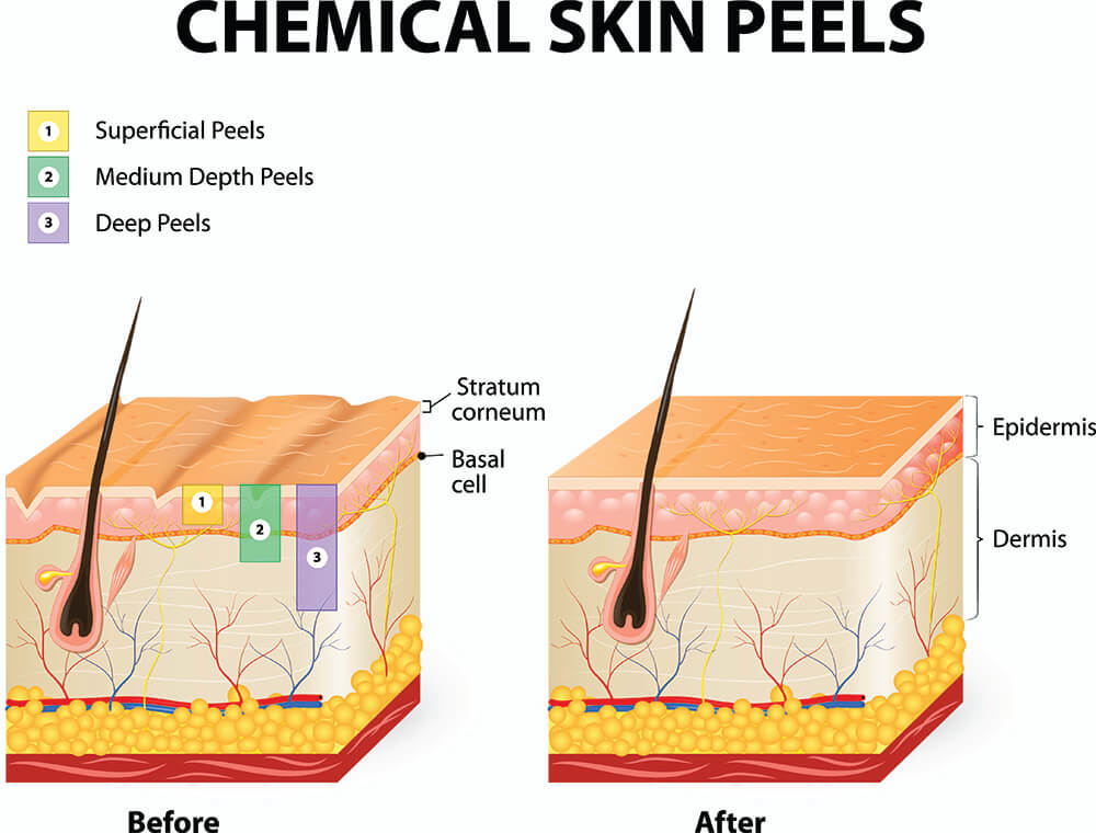 How deep do chemical peels go